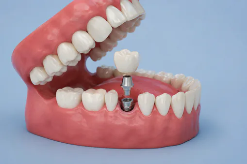 Dental Implants at Broadview Dental Clinic